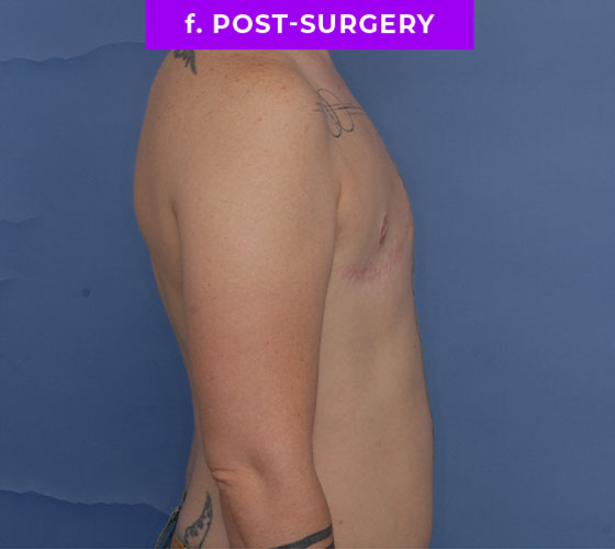 FEMALE-TO-MALE CHEST CONTOURING Patient 27 After 3