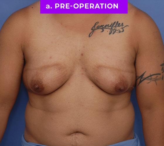 FEMALE-TO-MALE CHEST CONTOURING Patient 28 Before