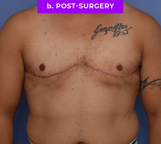 FEMALE-TO-MALE CHEST CONTOURING Patient 28 After
