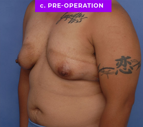 FEMALE-TO-MALE CHEST CONTOURING Patient 28 Before 2