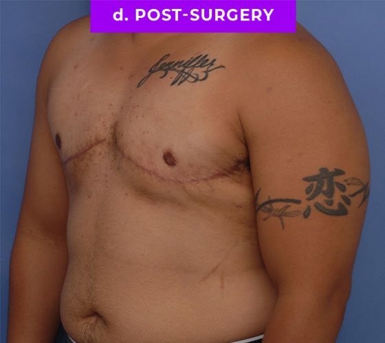 FEMALE-TO-MALE CHEST CONTOURING Patient 28 After 2