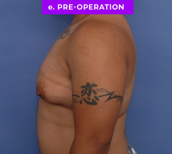FEMALE-TO-MALE CHEST CONTOURING Patient 28 Before 3