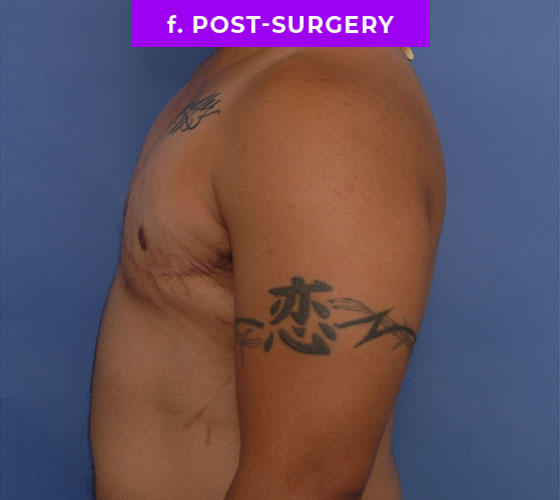 FEMALE-TO-MALE CHEST CONTOURING Patient 28 After 3