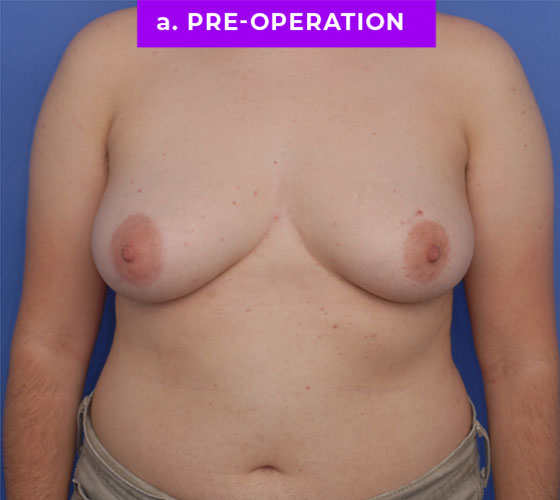 FEMALE-TO-MALE CHEST CONTOURING Patient 29 Before