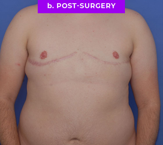 FEMALE-TO-MALE CHEST CONTOURING Patient 29 After