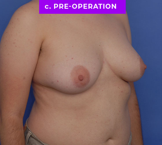 FEMALE-TO-MALE CHEST CONTOURING Patient 29 Before 2