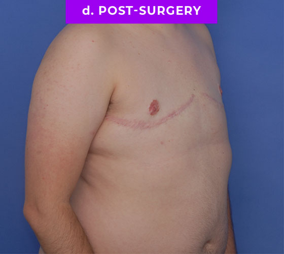 FEMALE-TO-MALE CHEST CONTOURING Patient 29 After 2