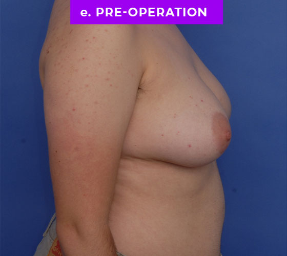 FEMALE-TO-MALE CHEST CONTOURING Patient 29 Before 3