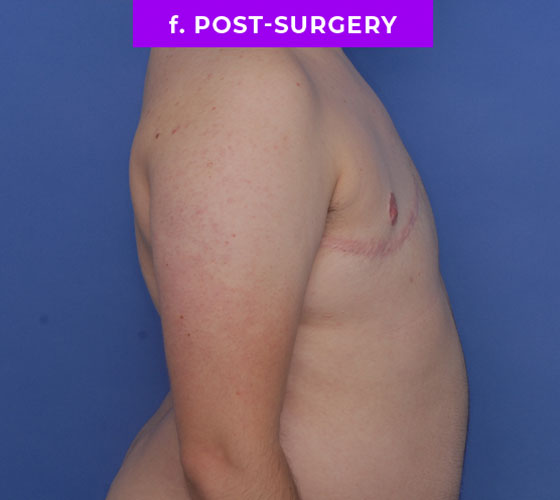 FEMALE-TO-MALE CHEST CONTOURING Patient 29 After 3