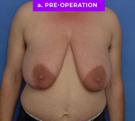 FEMALE-TO-MALE CHEST CONTOURING Patient 30 Before
