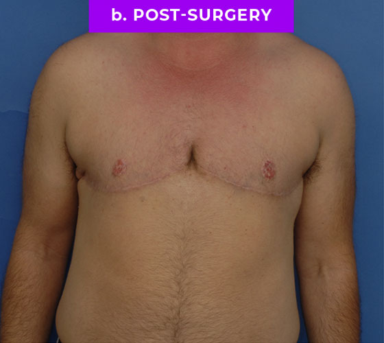 FEMALE-TO-MALE CHEST CONTOURING Patient 30 After