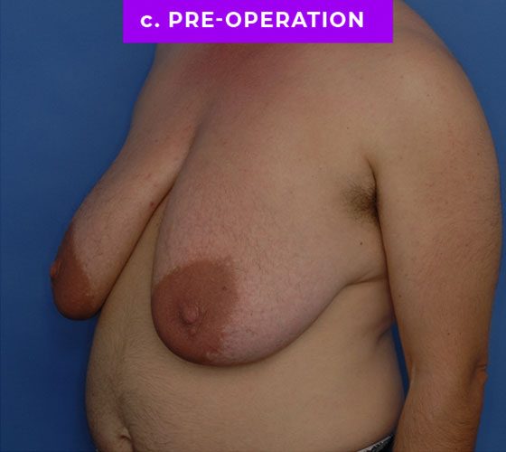 FEMALE-TO-MALE CHEST CONTOURING Patient 30 Before 2