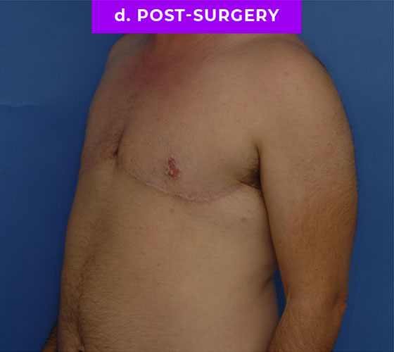 FEMALE-TO-MALE CHEST CONTOURING Patient 30 After 2