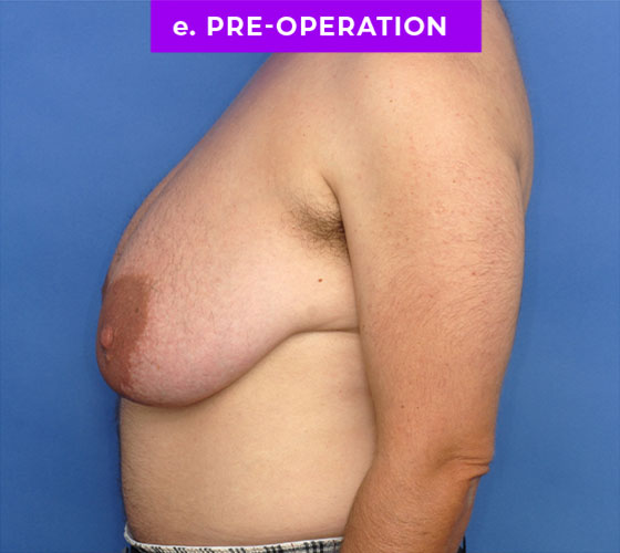 FEMALE-TO-MALE CHEST CONTOURING Patient 30 Before 3