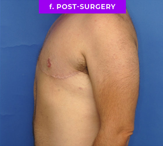 FEMALE-TO-MALE CHEST CONTOURING Patient 30 After 3