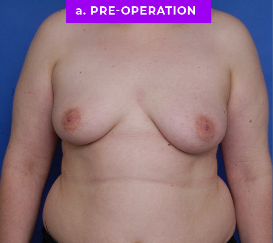 FEMALE-TO-MALE CHEST CONTOURING Patient 31 Before