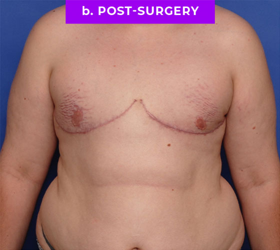 FEMALE-TO-MALE CHEST CONTOURING Patient 31 After