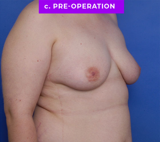 FEMALE-TO-MALE CHEST CONTOURING Patient 31 Before 2
