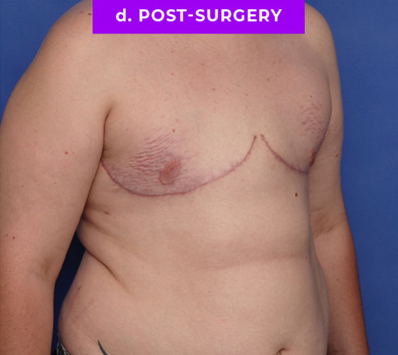 FEMALE-TO-MALE CHEST CONTOURING Patient 31 After 2