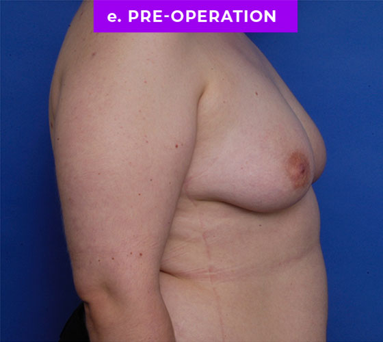 FEMALE-TO-MALE CHEST CONTOURING Patient 31 Before 3