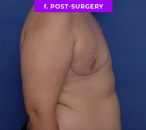 FEMALE-TO-MALE CHEST CONTOURING Patient 31 After 3