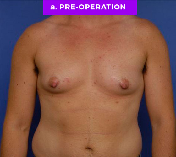 FEMALE-TO-MALE CHEST CONTOURING Patient 6 Before