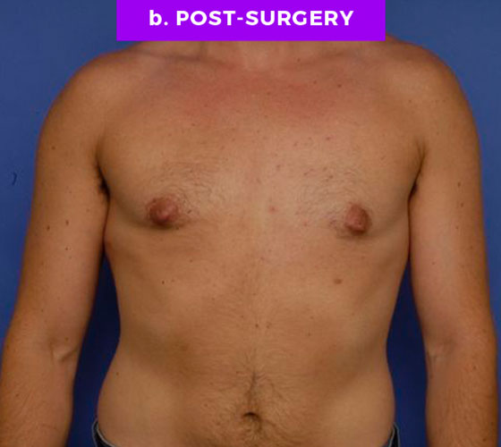FEMALE-TO-MALE CHEST CONTOURING Patient 6 After