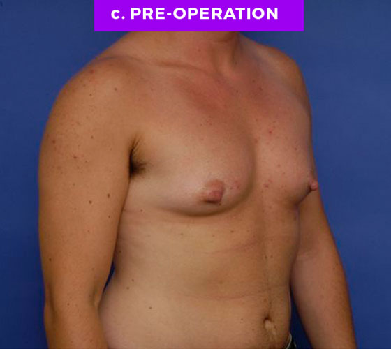 FEMALE-TO-MALE CHEST CONTOURING Patient 6 Before 2