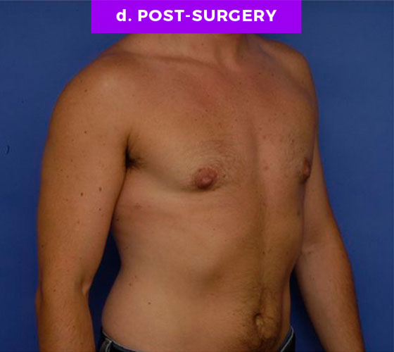 FEMALE-TO-MALE CHEST CONTOURING Patient 6 After 2