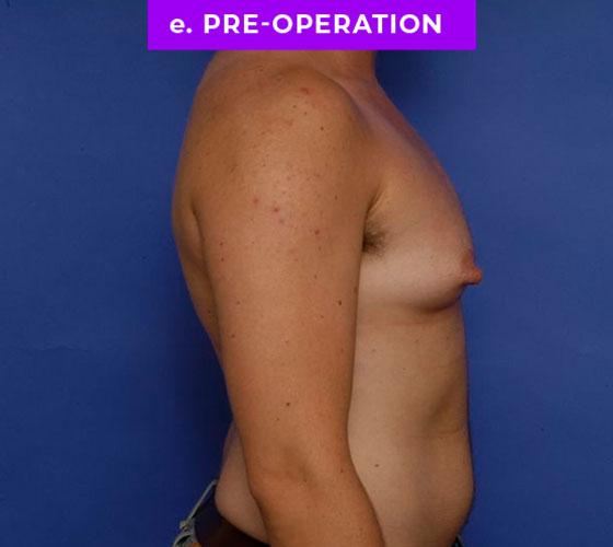 FEMALE-TO-MALE CHEST CONTOURING Patient 6 Before 3