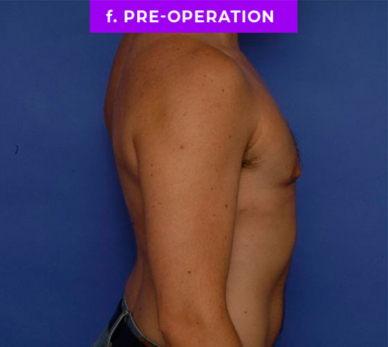 FEMALE-TO-MALE CHEST CONTOURING Patient 6 After 3