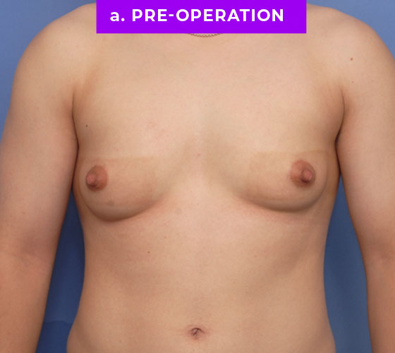 FEMALE-TO-MALE CHEST CONTOURING Patient 7 Before