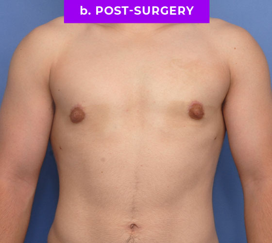 FEMALE-TO-MALE CHEST CONTOURING Patient 7 After