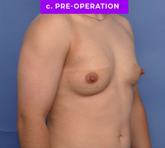 FEMALE-TO-MALE CHEST CONTOURING Patient 7 Before 2
