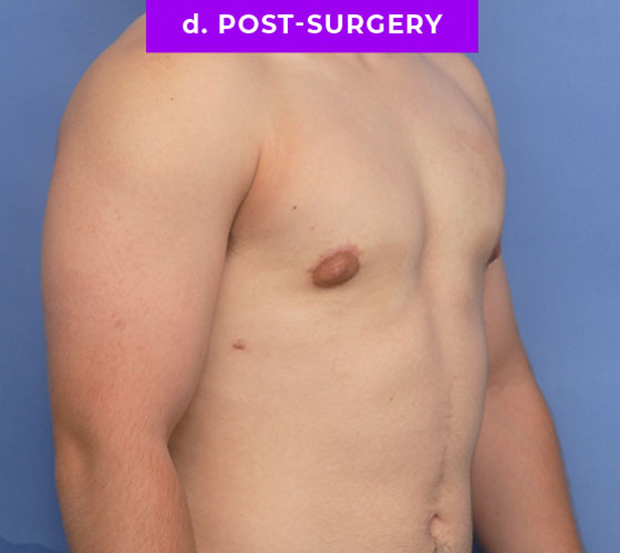 FEMALE-TO-MALE CHEST CONTOURING Patient 7 After 2