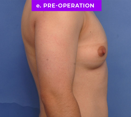 FEMALE-TO-MALE CHEST CONTOURING Patient 7 Before 3
