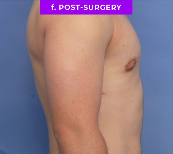 FEMALE-TO-MALE CHEST CONTOURING Patient 7 After 3