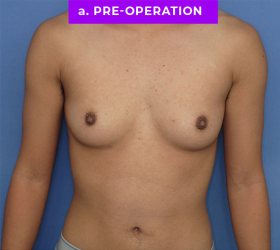 FEMALE-TO-MALE CHEST CONTOURING Patient 9 Before