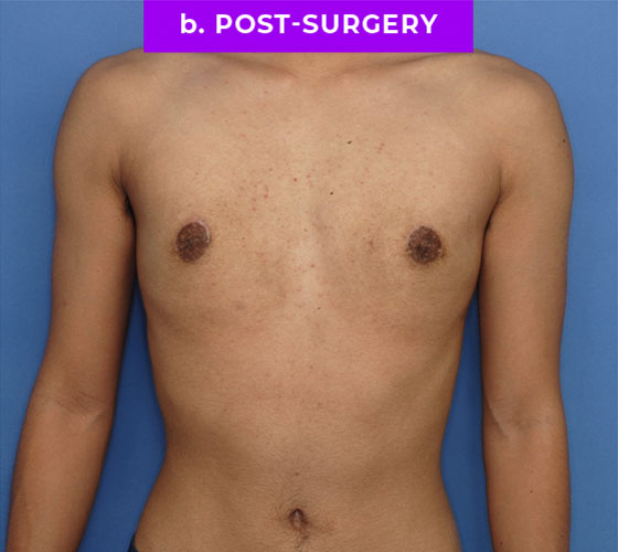 FEMALE-TO-MALE CHEST CONTOURING Patient 9 After