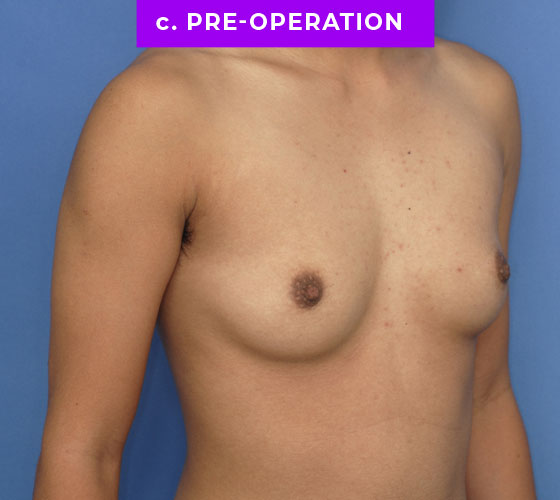 FEMALE-TO-MALE CHEST CONTOURING Patient 9 Before 2