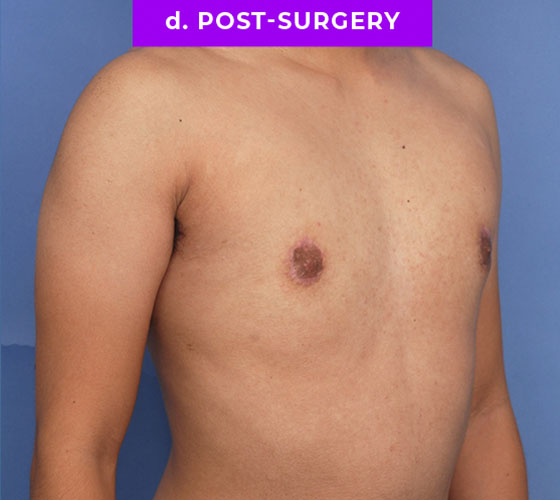 FEMALE-TO-MALE CHEST CONTOURING Patient 9 After 2
