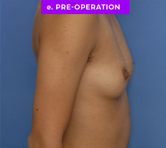 FEMALE-TO-MALE CHEST CONTOURING Patient 9 Before 3