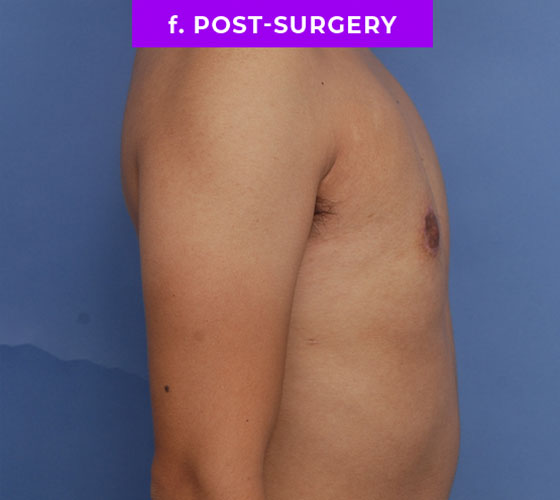 FEMALE-TO-MALE CHEST CONTOURING Patient 9 After 3