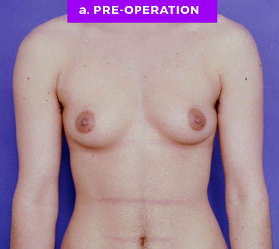 FEMALE-TO-MALE CHEST CONTOURING Patient 4 Before