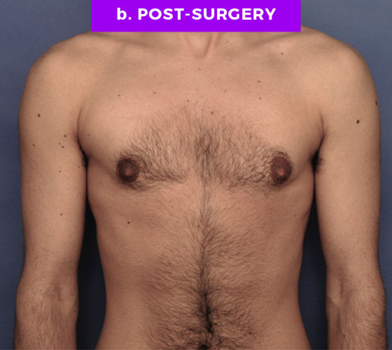 FEMALE-TO-MALE CHEST CONTOURING Patient 4 After