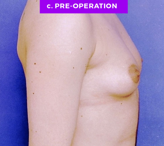 FEMALE-TO-MALE CHEST CONTOURING Patient 4 Before 2