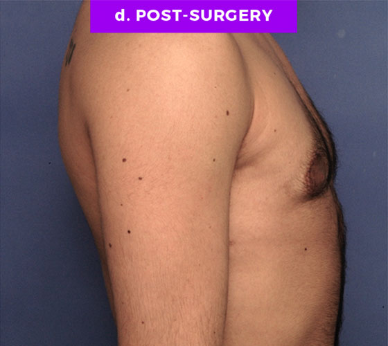 FEMALE-TO-MALE CHEST CONTOURING Patient 4 After 2