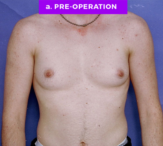FEMALE-TO-MALE CHEST CONTOURING Patient 5 Before