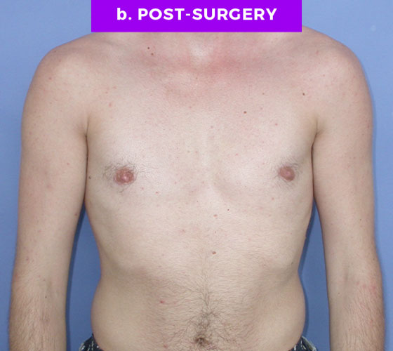 FEMALE-TO-MALE CHEST CONTOURING Patient 5 After