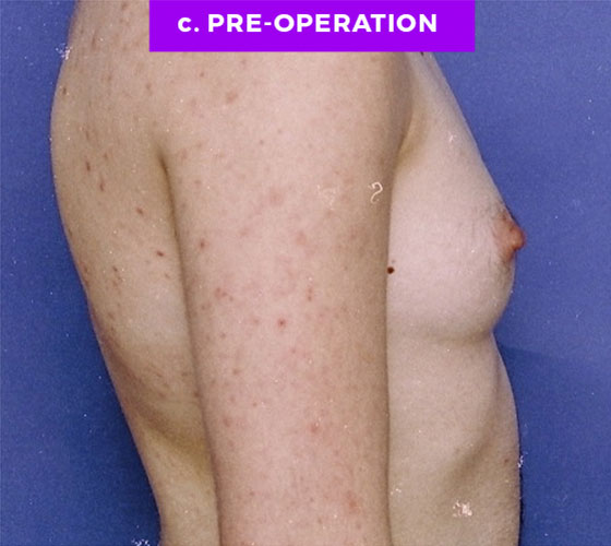 FEMALE-TO-MALE CHEST CONTOURING Patient 5 Before 2